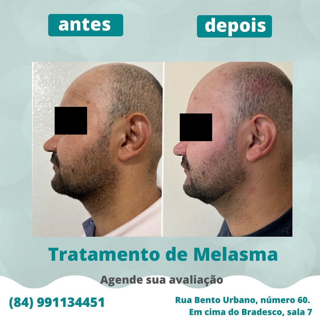 Caso de melasma cuidado - Foto 6
